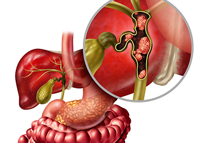bile duct cancer image