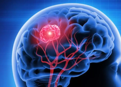 brain tumor image