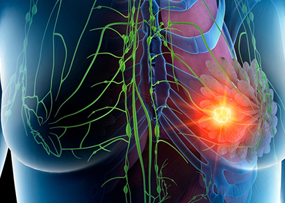 breast cancer image