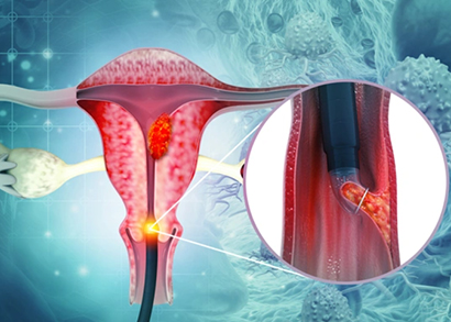 cervical cancer image