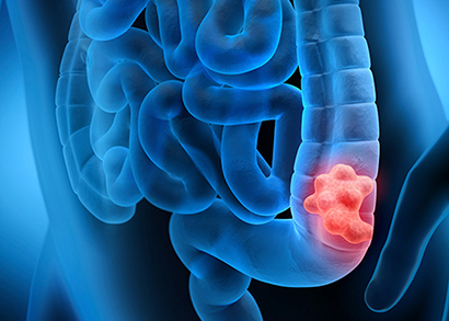 colon cancer image