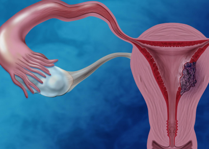endometrial cancer image