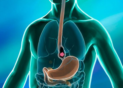 esophageal cancer image