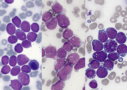 leukemia image
