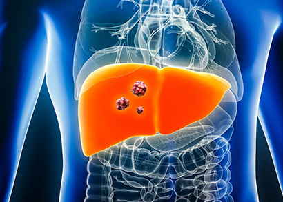 liver cancer image