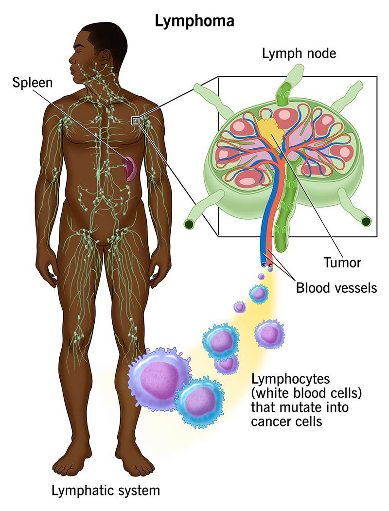 lymphoma image