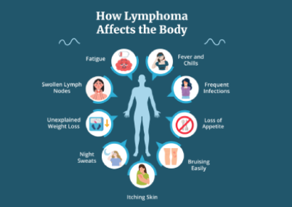 lymphoma image