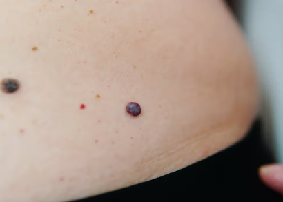 melanoma image