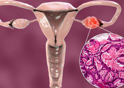 ovarian cancer image