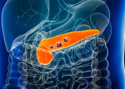 pancreatic cancer image