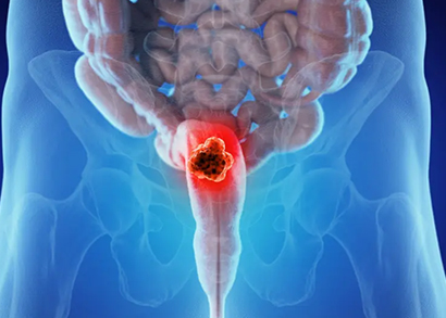 rectal cancer image