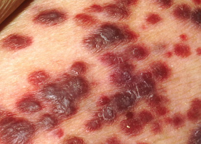 sarcoma image