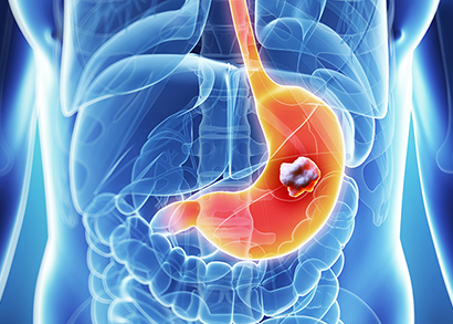 stomach cancer image