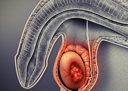 testicular cancer image