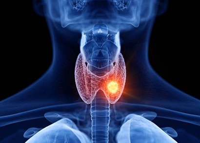 thyroid cancer image