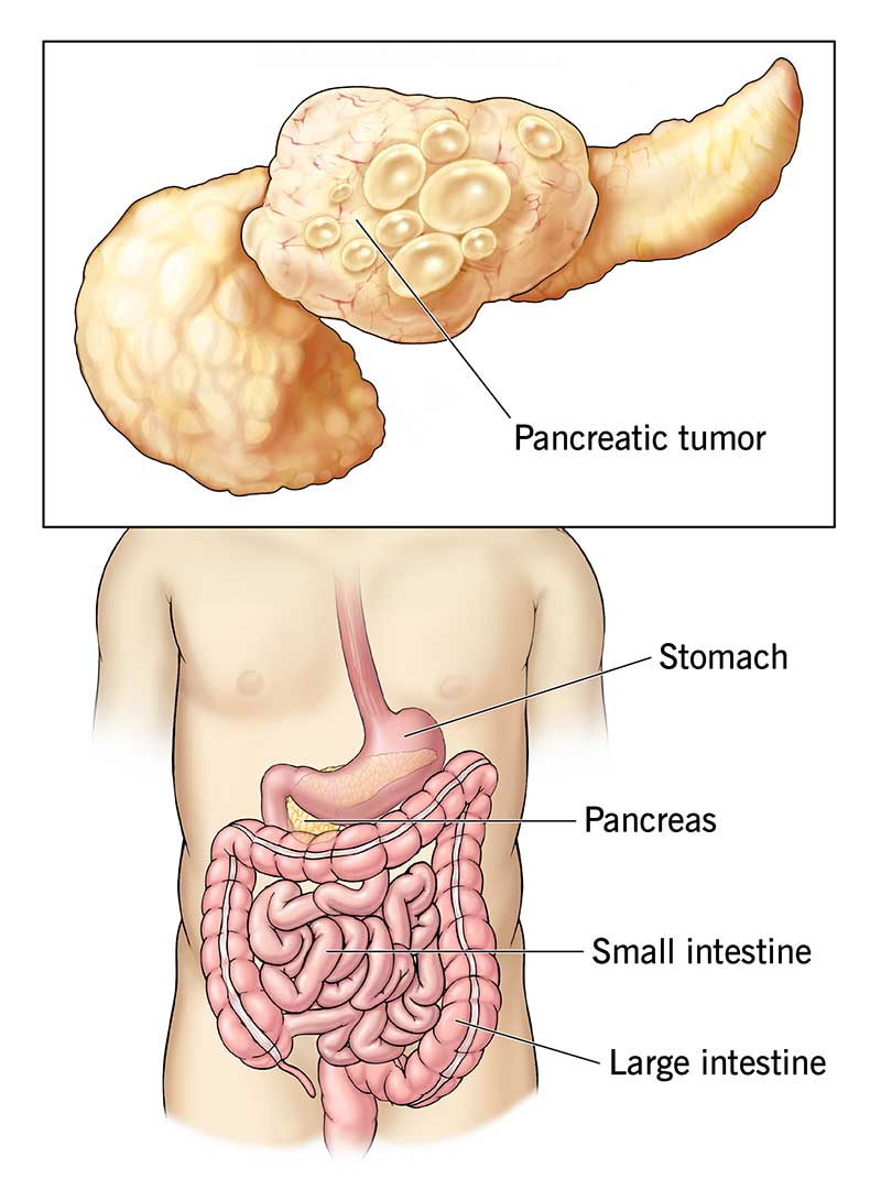 lymphoma image