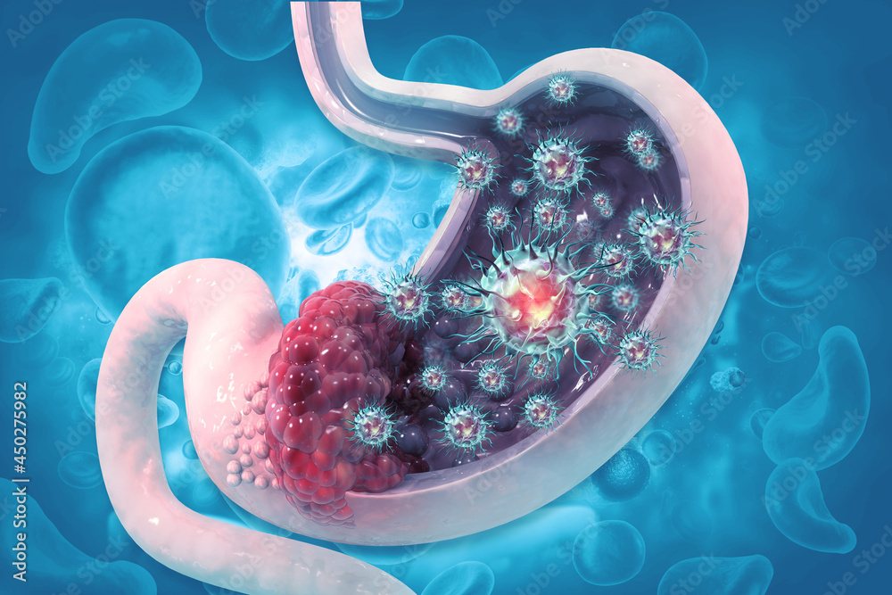 lymphoma image