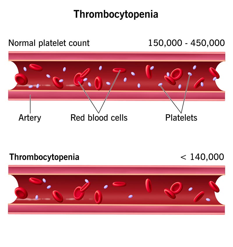 lymphoma image