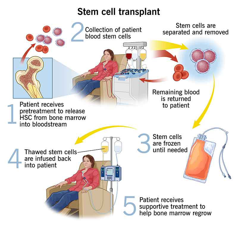 stem-cell-transplant-2.jpg